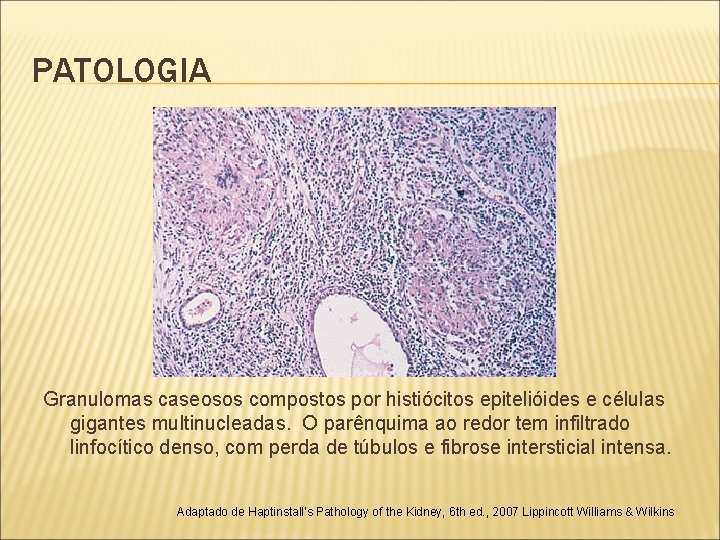PATOLOGIA Granulomas caseosos compostos por histiócitos epitelióides e células gigantes multinucleadas. O parênquima ao