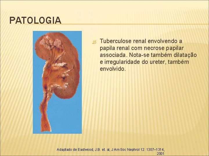 PATOLOGIA Tuberculose renal envolvendo a papila renal com necrose papilar associada. Nota-se também dilatação