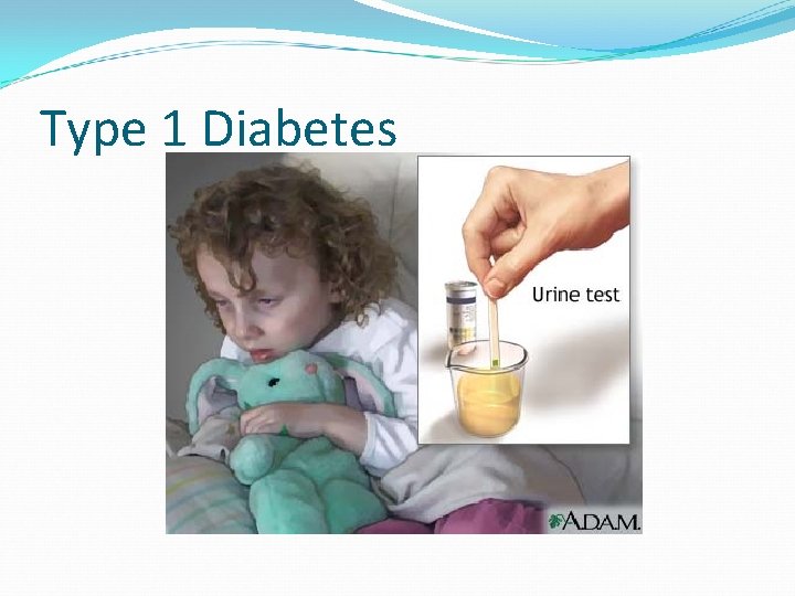 Type 1 Diabetes 