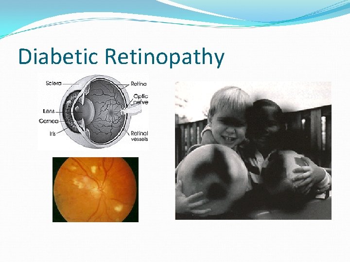 Diabetic Retinopathy 