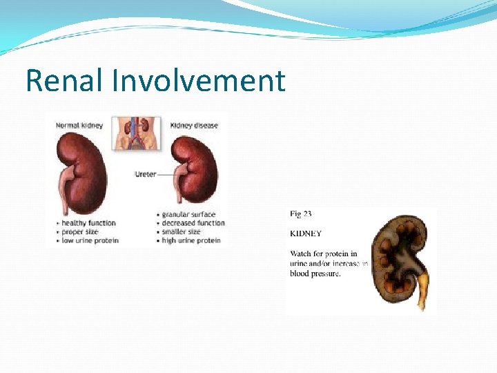 Renal Involvement 