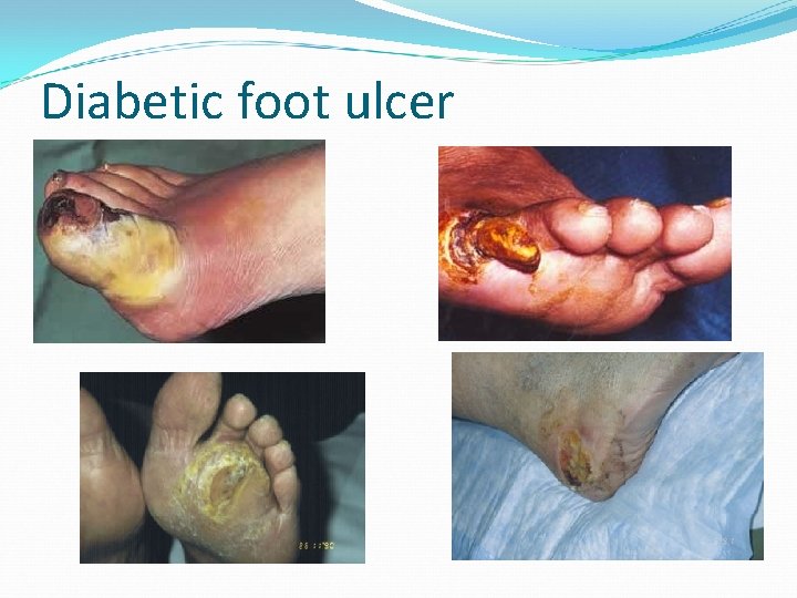 Diabetic foot ulcer 