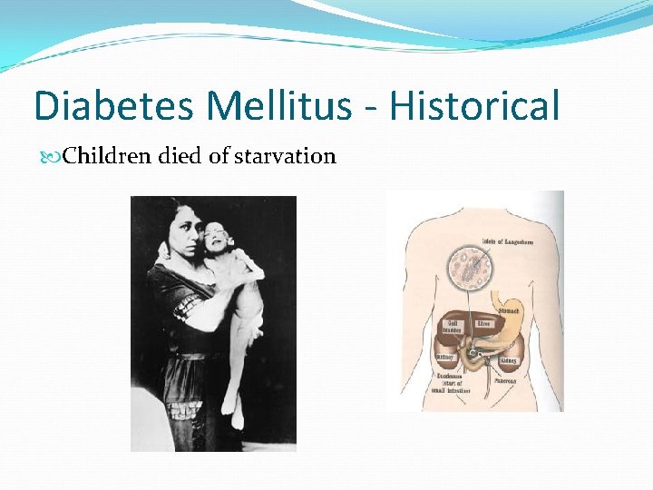 Diabetes Mellitus - Historical Children died of starvation 