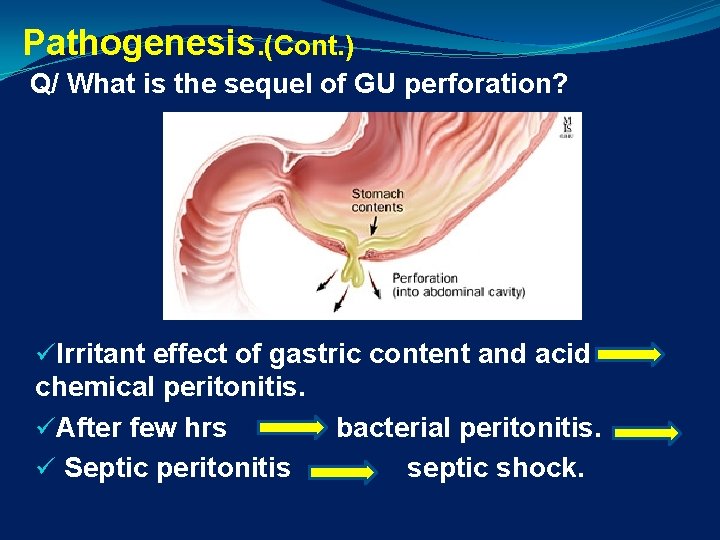 Pathogenesis. (Cont. ) Q/ What is the sequel of GU perforation? üIrritant effect of