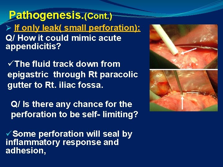 Pathogenesis. (Cont. ) Ø If only leak( small perforation): Q/ How it could mimic