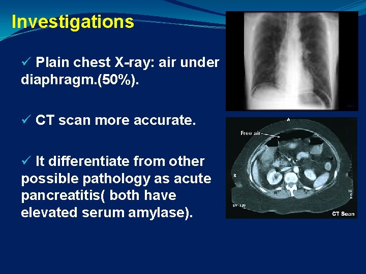 Investigations ü Plain chest X-ray: air under diaphragm. (50%). ü CT scan more accurate.