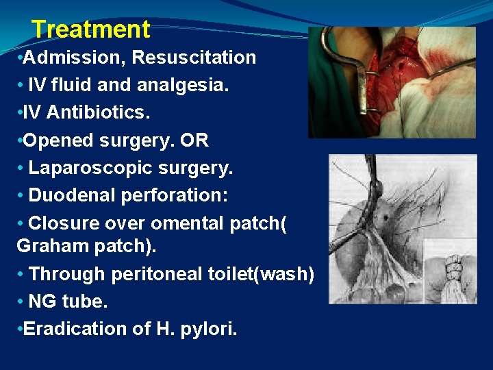 Treatment • Admission, Resuscitation • IV fluid analgesia. • IV Antibiotics. • Opened surgery.