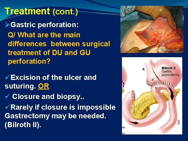 Treatment (cont. ) ØGastric perforation: Q/ What are the main differences between surgical treatment