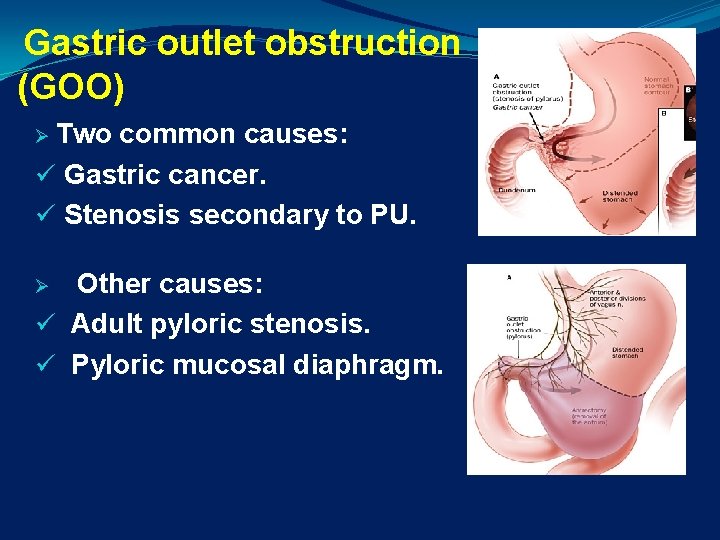 Gastric outlet obstruction (GOO) Ø Two common causes: ü Gastric cancer. ü Stenosis secondary