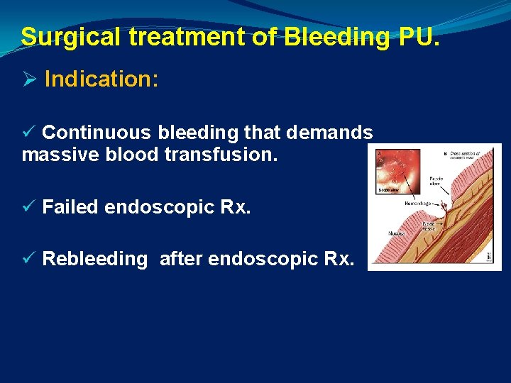 Surgical treatment of Bleeding PU. Ø Indication: ü Continuous bleeding that demands massive blood