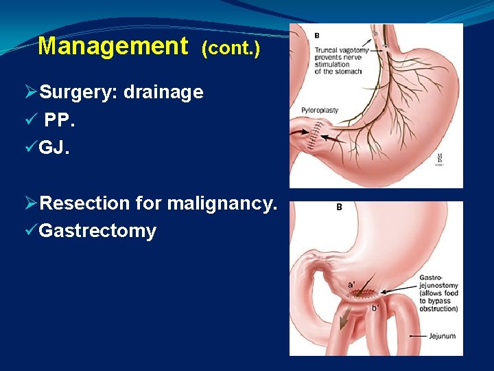 Management (cont. ) ØSurgery: drainage ü PP. üGJ. ØResection for malignancy. üGastrectomy 