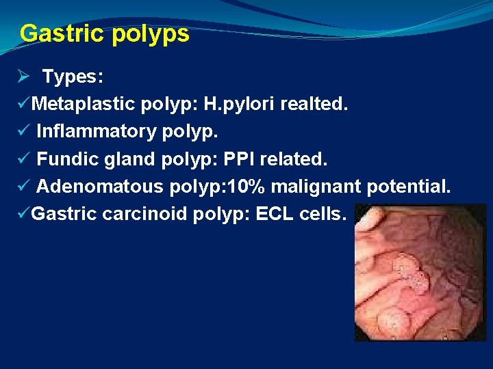 Gastric polyps Ø Types: üMetaplastic polyp: H. pylori realted. ü Inflammatory polyp. ü Fundic