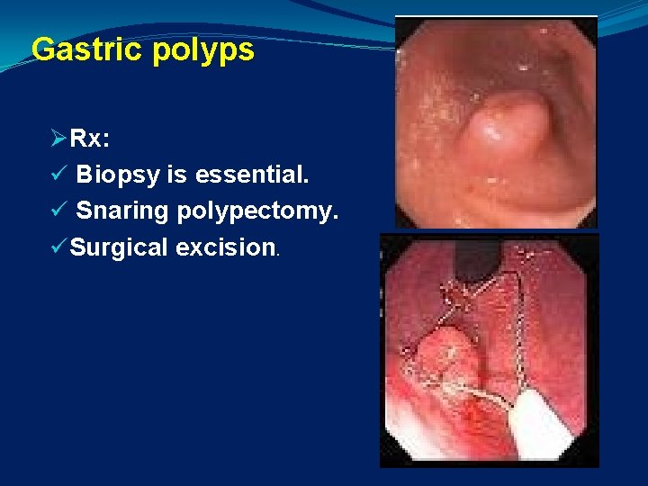 Gastric polyps ØRx: ü Biopsy is essential. ü Snaring polypectomy. üSurgical excision. 