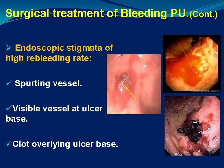 Surgical treatment of Bleeding PU. (Cont. ) Ø Endoscopic stigmata of high rebleeding rate: