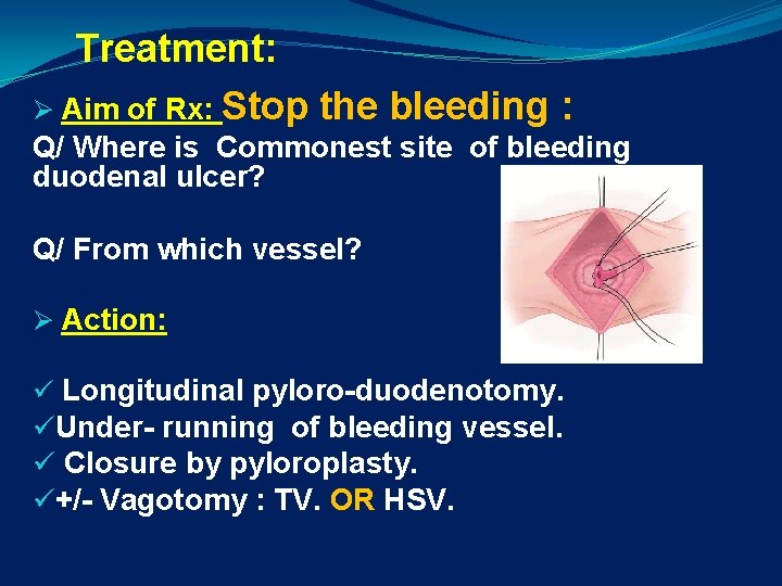 Treatment: Ø Aim of Rx: Stop the bleeding : Q/ Where is Commonest site