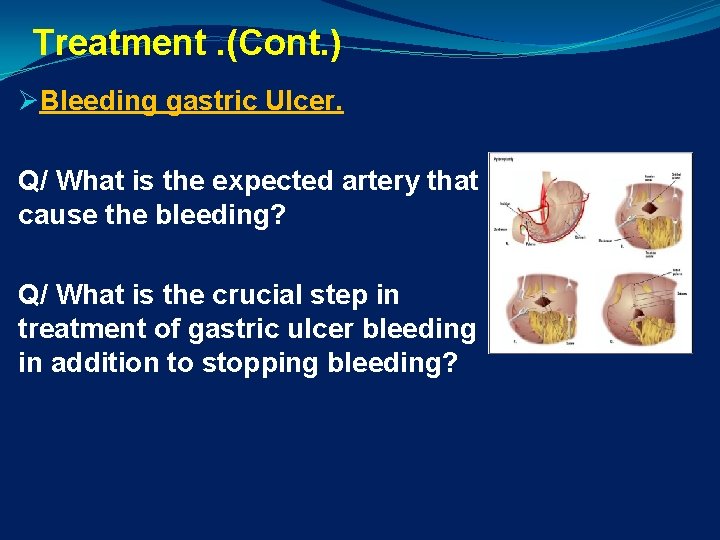 Treatment. (Cont. ) ØBleeding gastric Ulcer. Q/ What is the expected artery that cause