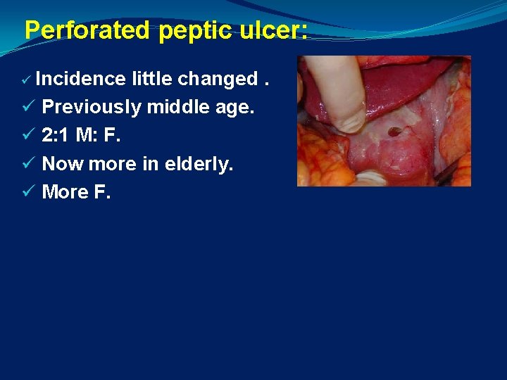 Perforated peptic ulcer: ü Incidence little changed. ü Previously middle age. ü 2: 1