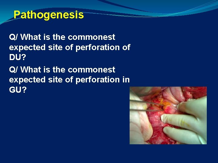 Pathogenesis Q/ What is the commonest expected site of perforation of DU? Q/ What