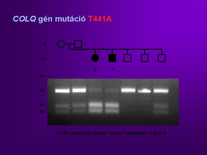 COLQ gén mutáció T 441 A I II 2 1 bp 150 84 66