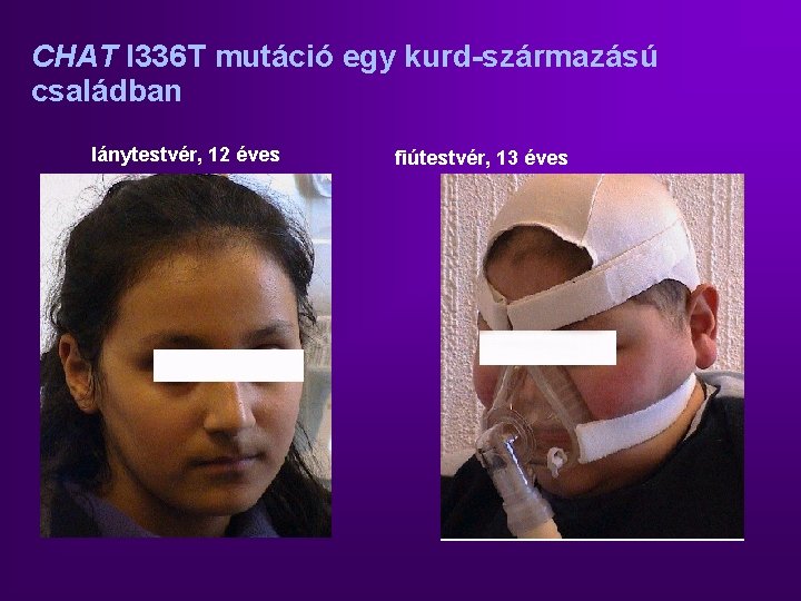 CHAT I 336 T mutáció egy kurd-származású családban lánytestvér, 12 éves fiútestvér, 13 éves