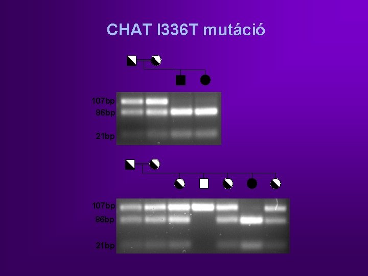 CHAT I 336 T mutáció 107 bp 86 bp 21 bp 
