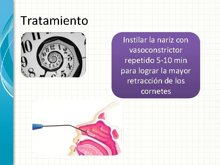 Tratamiento Instilar la nariz con vasoconstrictor repetido 5 -10 min para lograr la mayor