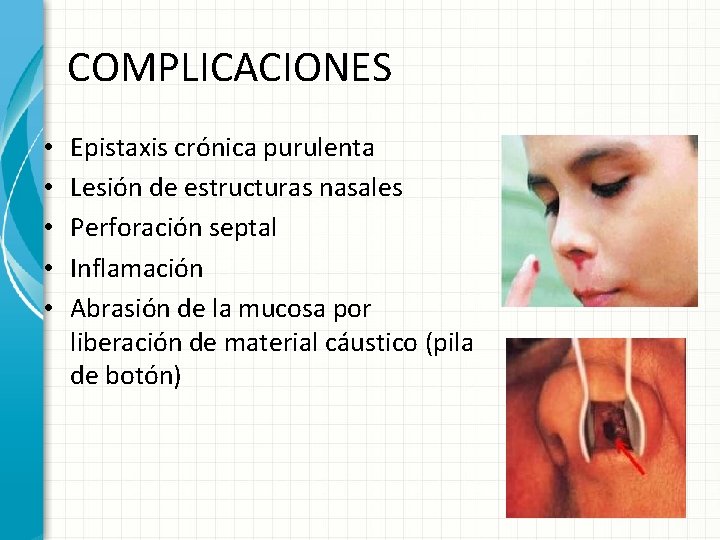 COMPLICACIONES • • • Epistaxis crónica purulenta Lesión de estructuras nasales Perforación septal Inflamación