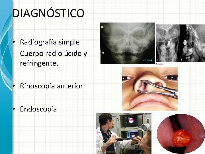 DIAGNÓSTICO • Radiografía simple - Cuerpo radiolúcido y refringente. • Rinoscopia anterior • Endoscopia