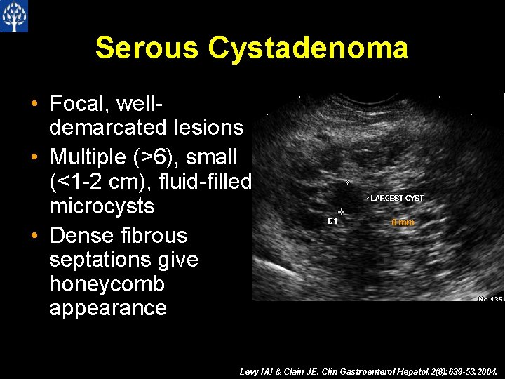 Serous Cystadenoma • Focal, welldemarcated lesions • Multiple (>6), small (<1 -2 cm), fluid-filled