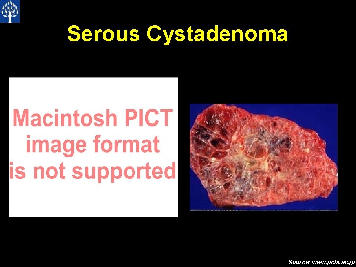 Serous Cystadenoma Source: www. jichi. ac. jp 