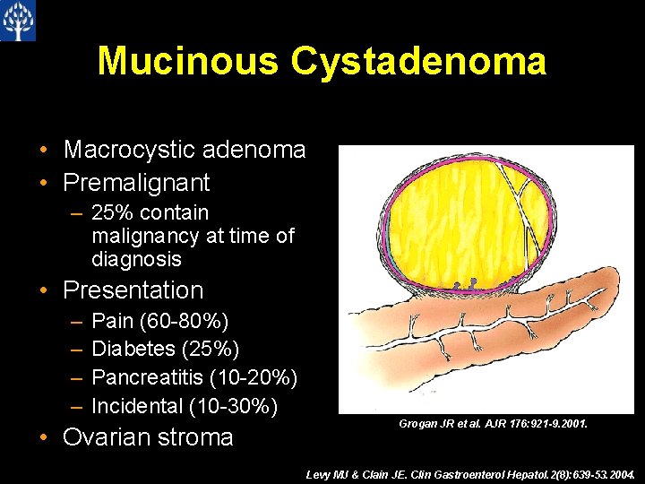 Mucinous Cystadenoma • Macrocystic adenoma • Premalignant – 25% contain malignancy at time of