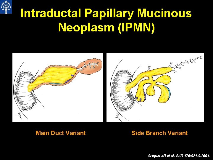 Intraductal Papillary Mucinous Neoplasm (IPMN) Main Duct Variant Side Branch Variant Grogan JR et