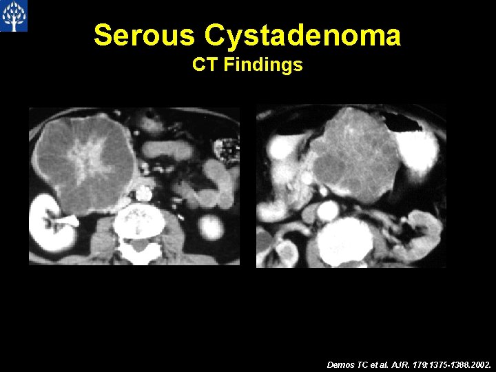 Serous Cystadenoma CT Findings Demos TC et al. AJR. 179: 1375 -1388. 2002. 