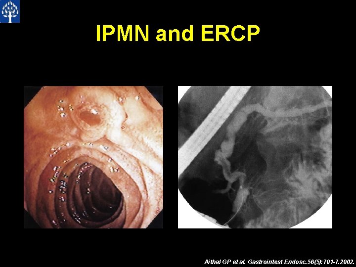 IPMN and ERCP Aithal GP et al. Gastrointest Endosc. 56(5): 701 -7. 2002. 