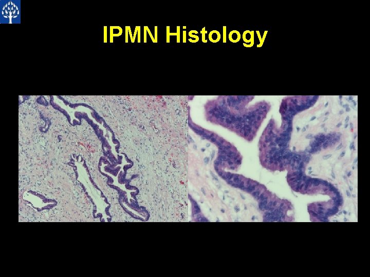 IPMN Histology 