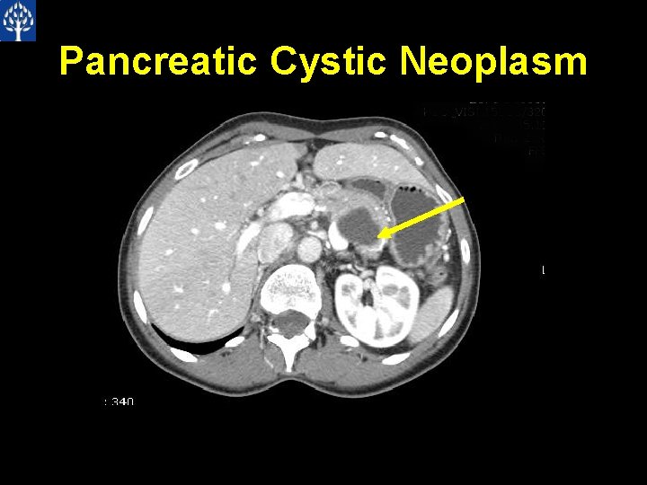 Pancreatic Cystic Neoplasm 