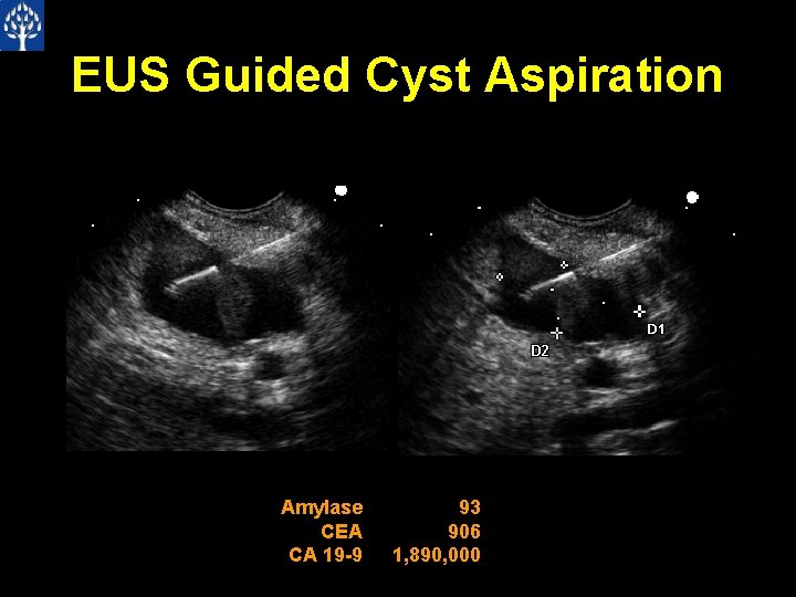 EUS Guided Cyst Aspiration Amylase CEA CA 19 -9 93 906 1, 890, 000