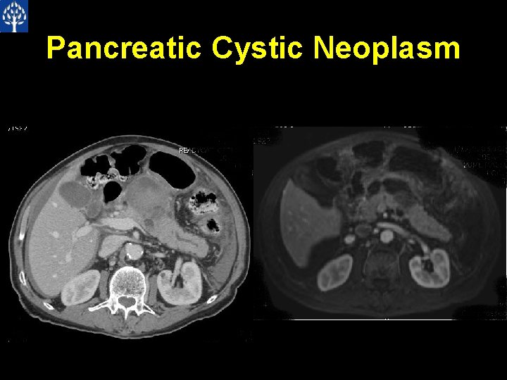 Pancreatic Cystic Neoplasm 