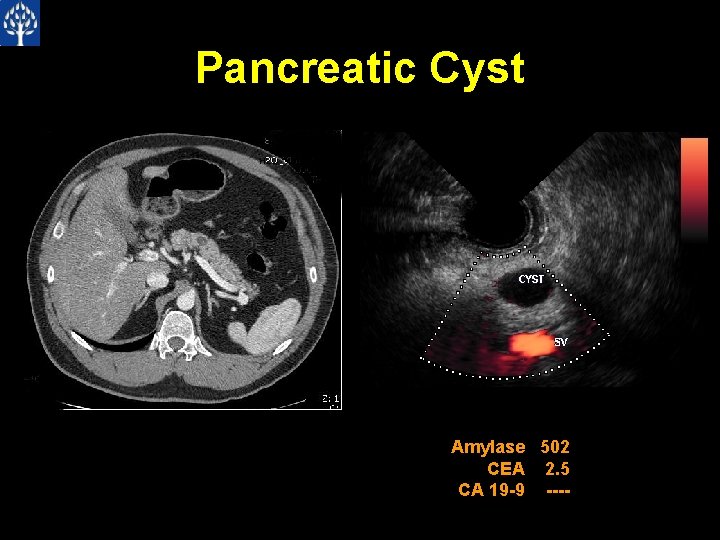 Pancreatic Cyst Amylase 502 CEA 2. 5 CA 19 -9 ---- 