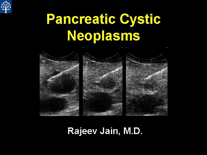 Pancreatic Cystic Neoplasms Rajeev Jain, M. D. 