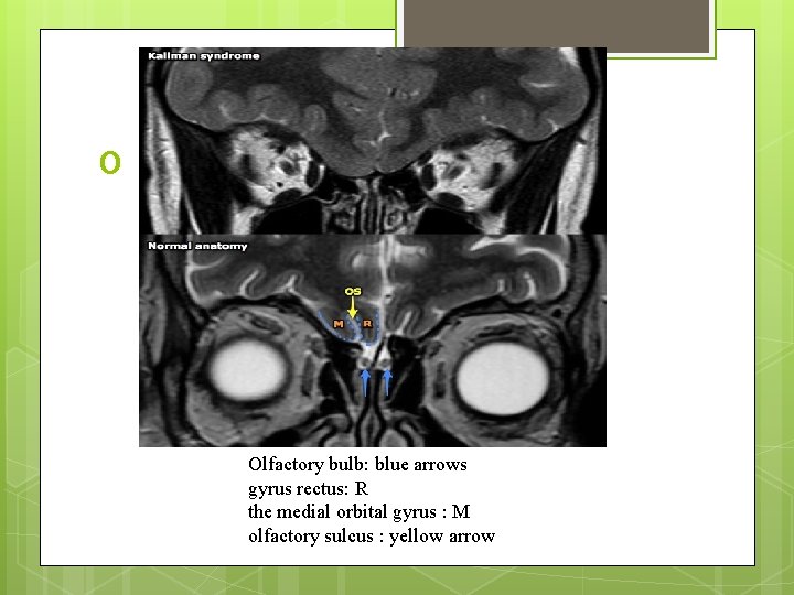 o Olfactory bulb: blue arrows gyrus rectus: R the medial orbital gyrus : M