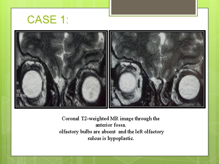 CASE 1: Coronal T 2 -weighted MR image through the anterior fossa. olfactory bulbs