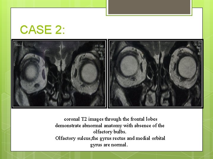 CASE 2: coronal T 2 images through the frontal lobes demonstrate abnormal anatomy with