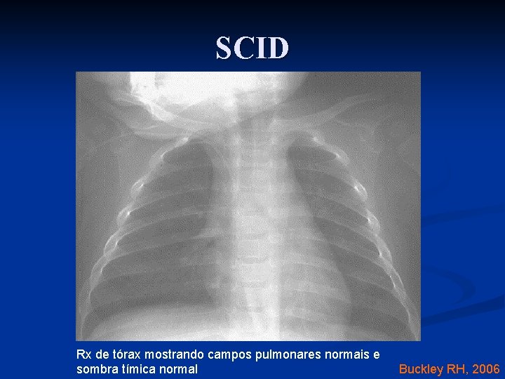 SCID Rx de tórax mostrando campos pulmonares normais e sombra tímica normal Buckley RH,
