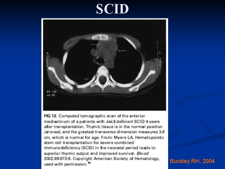 SCID Buckley RH, 2004 