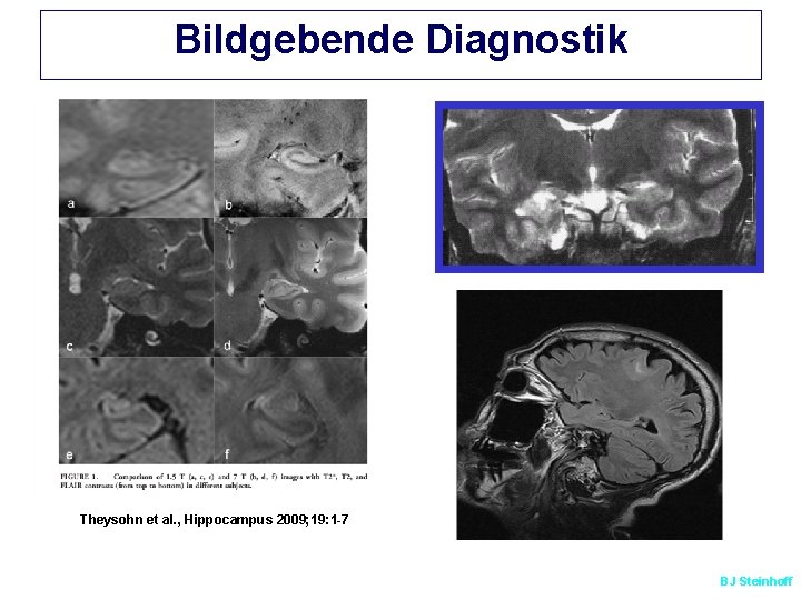 Bildgebende Diagnostik Theysohn et al. , Hippocampus 2009; 19: 1 -7 BJ Steinhoff 