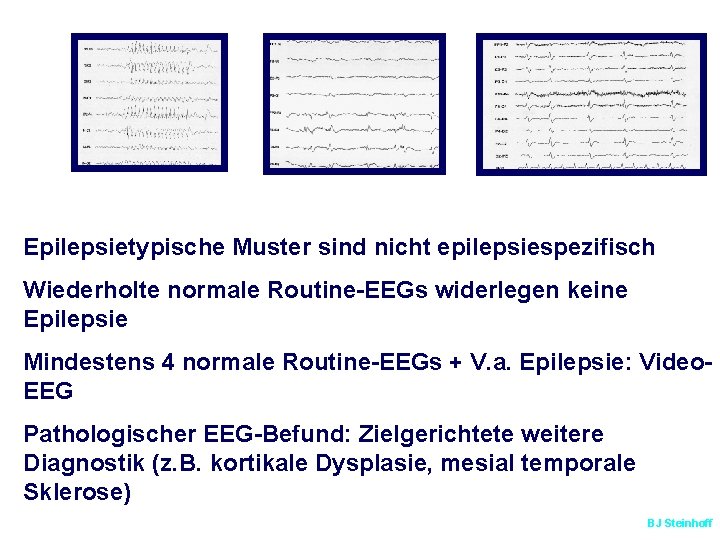 Epilepsietypische Muster sind nicht epilepsiespezifisch Wiederholte normale Routine-EEGs widerlegen keine Epilepsie Mindestens 4 normale