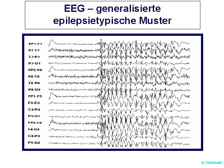 EEG – generalisierte epilepsietypische Muster BJ Steinhoff 