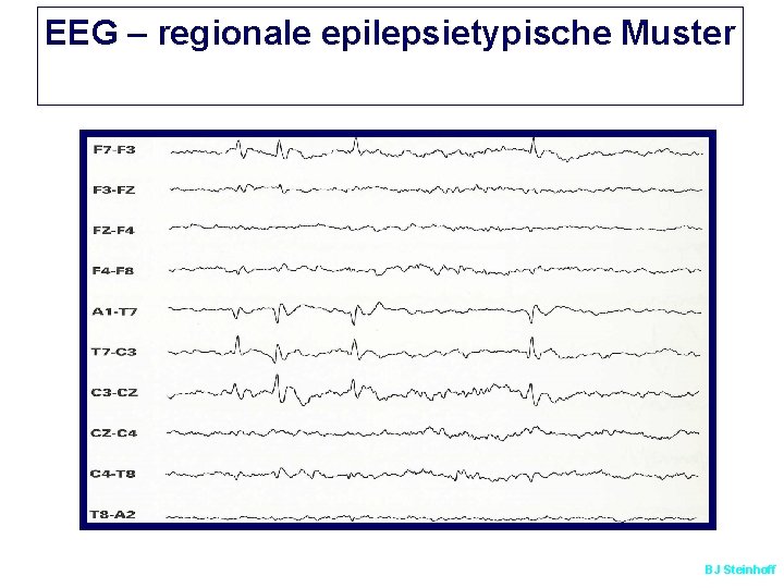 EEG – regionale epilepsietypische Muster BJ Steinhoff 