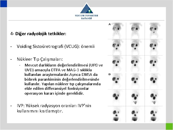 4 - Diğer radyolojik tetkikler: - Voiding Sistoüretrografi (VCUG): önemli - Nükleer Tıp Çalışmaları:
